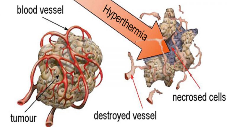 hyperthermia