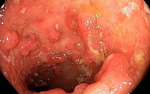 Effect on ulcerative colitis