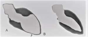 TakoTsubo heart_scheme