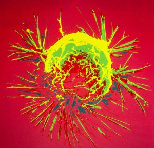 breast cancer cell