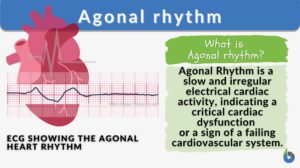 Agonal rhythm definition and example