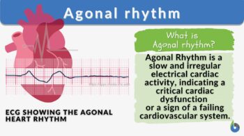 Agonal rhythm definition and example
