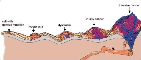 Cancer_progression