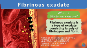 Fibrinous exudate definition and example