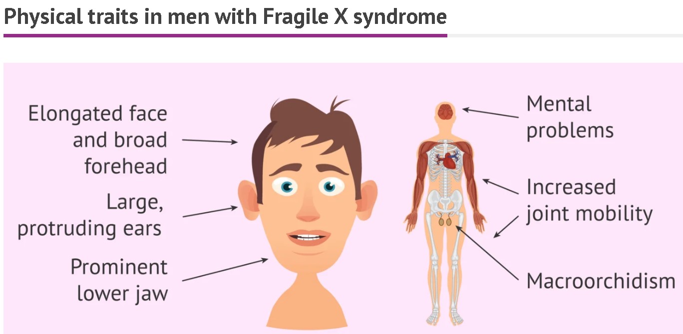 Fragile X syndrome clinical signs in men