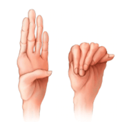 Human hand with Marfan syndrome