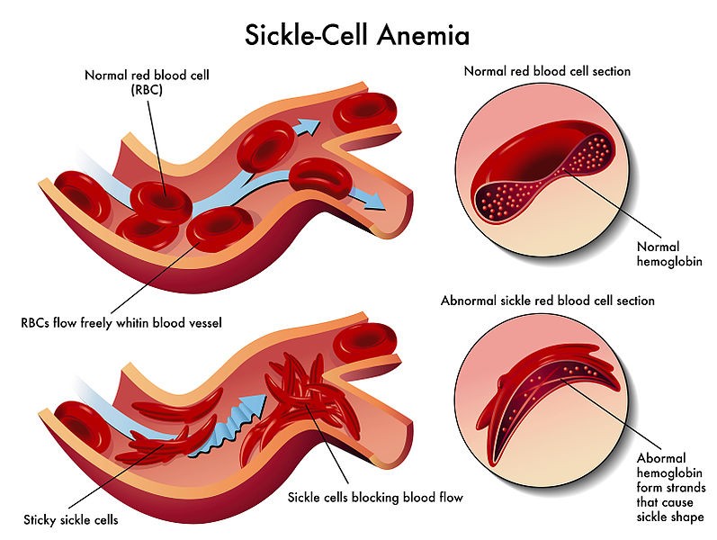 Sickle cell anemia vs normal