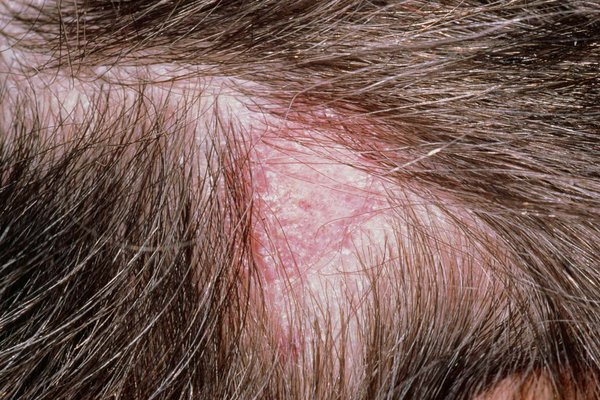 Tinea capitis on scalp