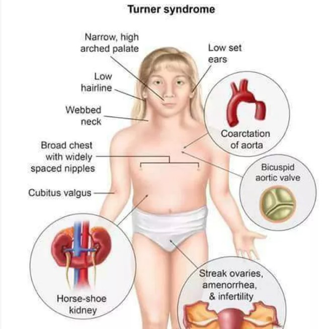 Clinical signs of Turner syndrome
