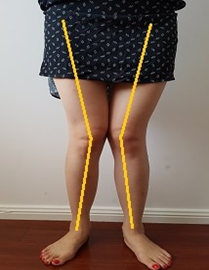 Valgus knees