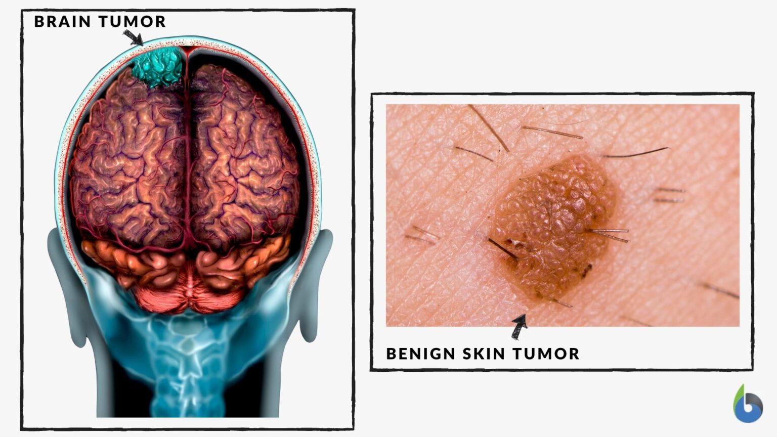 Benign - Definition and Examples - Biology Online Dictionary