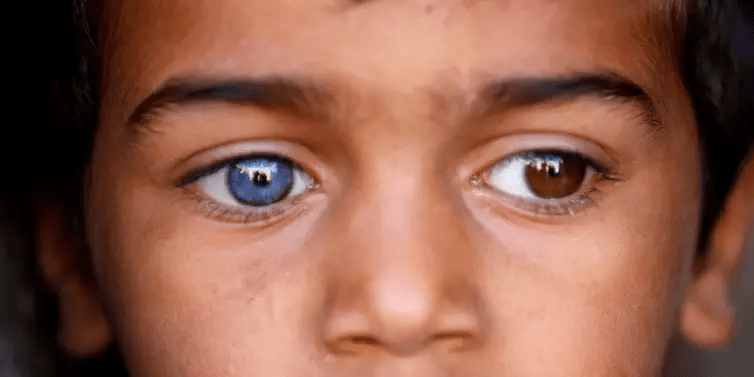 eye colors in human chimerism