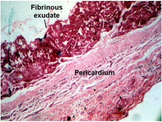 fibrinous exudate in pericardium