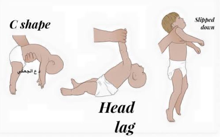 hypotonia in infant