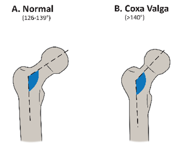 coxa valga