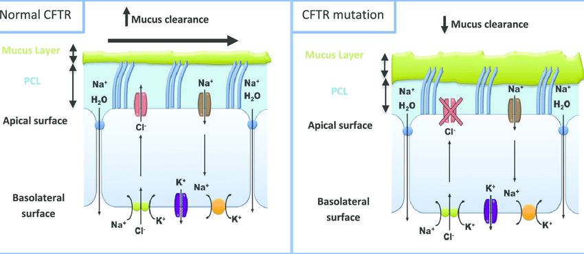 nonsense mutation in the CFTR protein