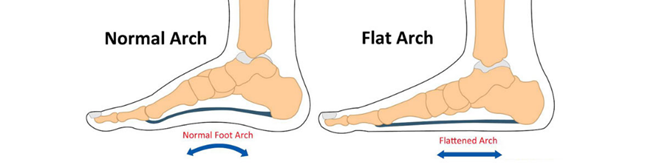 normal foot and Flat foot or Pes valgus