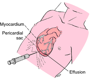 pericardial cytology sample collection