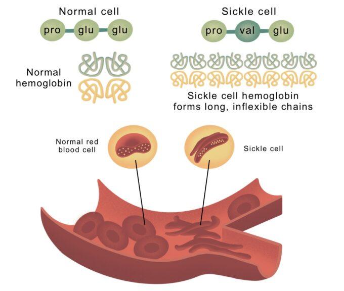 sickle cell anemia
