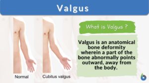 valgus definition and example