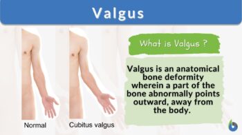 valgus definition and example