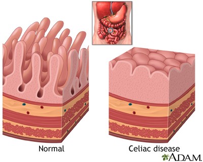 normal intestine vs intestine with celiac disease