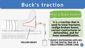 Buck's traction definition and example