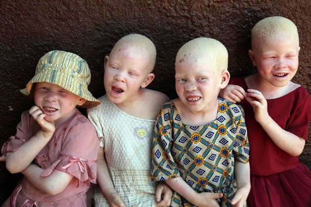 Albinism in Humans