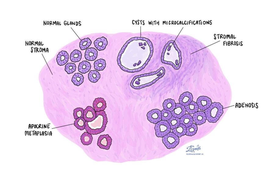 Apocrine metaplasia