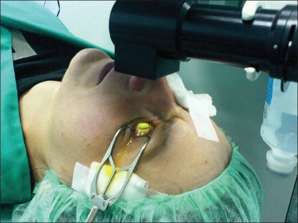 corneal collagen cross-linking