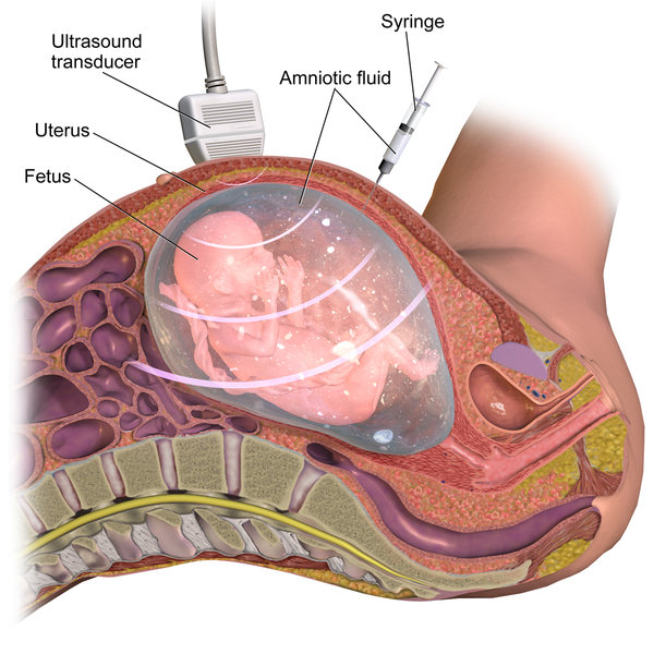 Amniocentesis procedure