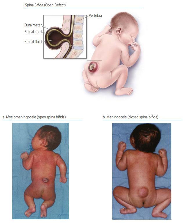 Complication of spina bifida
