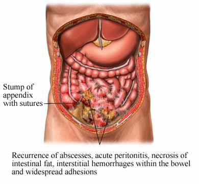 Peritonitis condition