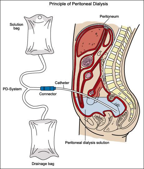 Representative illustration of the procedure of peritoneal dialysis