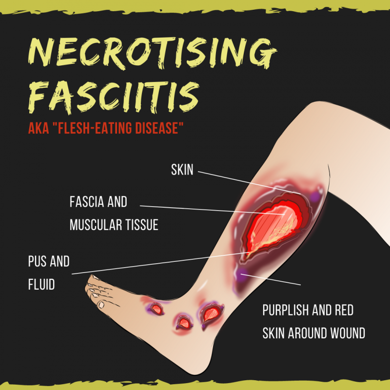 S. pyogenes pathogenic agent of necrotizing fasciitis (flesh-eating disease)