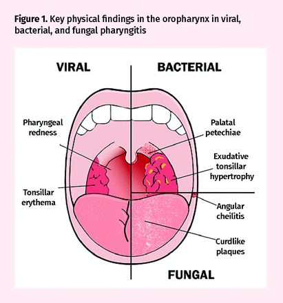 different causes for pharyngitis