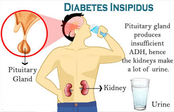 Diuresis in Diabetes Insipidus