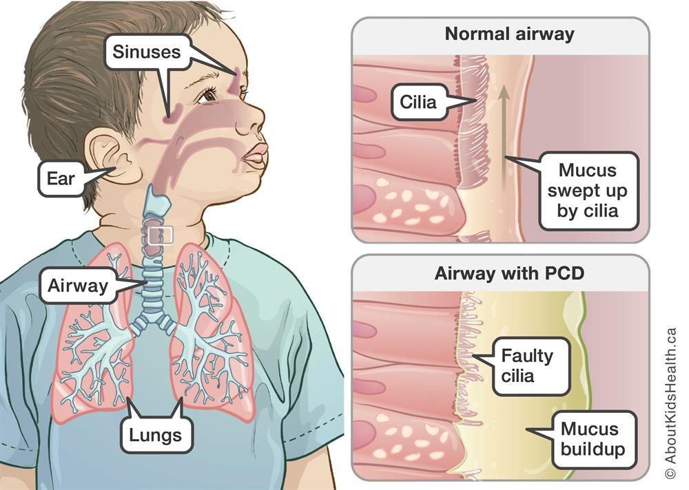 Impact of Primary Ciliary Dyskinesia on a child