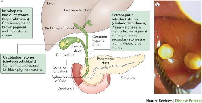 different types of gallstones