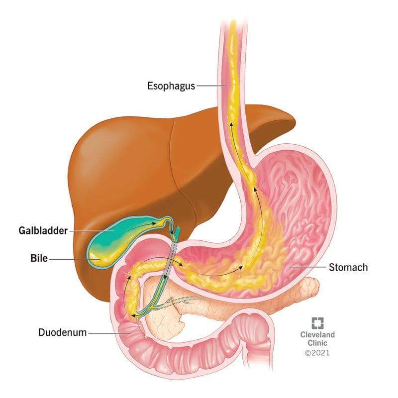 how bile refluxes