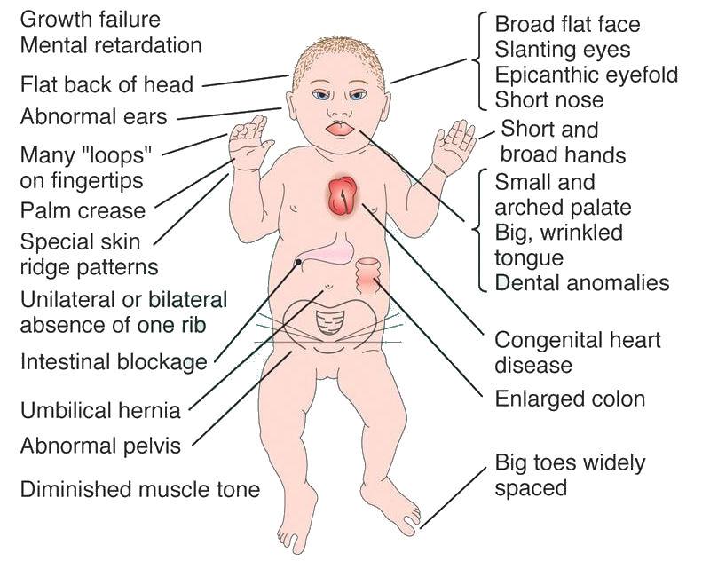 Common symptoms of Trisomy 21
