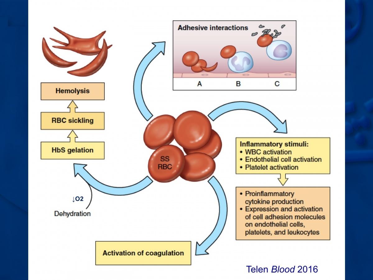 RBCs in sickle cell anemia